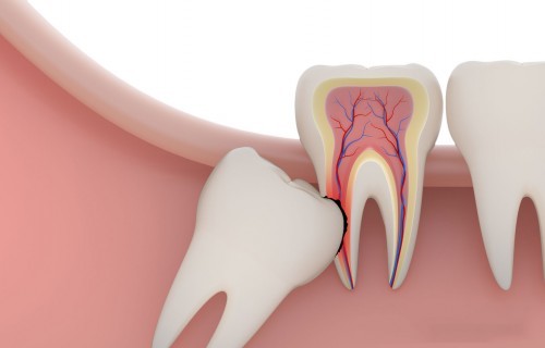 wisdom tooth 500x320