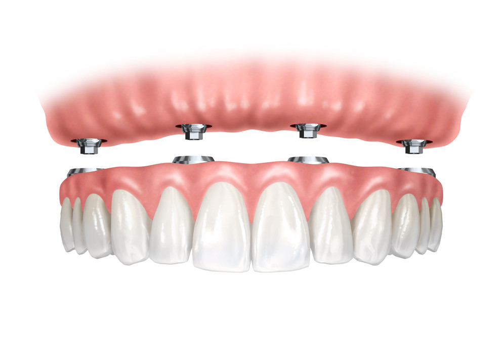 Implant retained denture