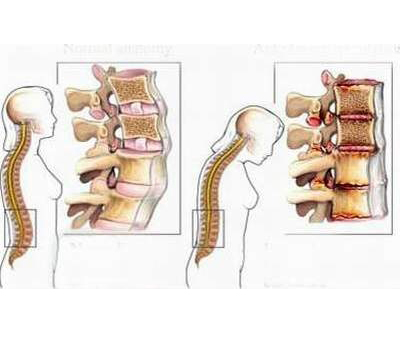 THỰC PHẨM CHỨC NĂNG   NHÓM XƯƠNG KHỚP