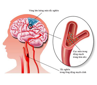 THỰC PHẨM CHỨC NĂNG   TUẦN HOÀN NÃO